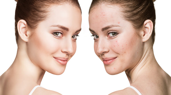 Mirror Image Of Woman With Clear Skin And Acne Skin - Vu Skin System