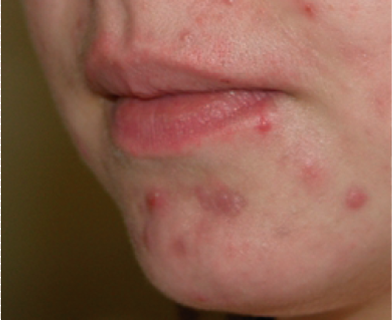 Chin & Mouth With Acne - Vu Skin System
