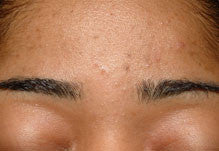 Forehead With Acne - Vu Skin System