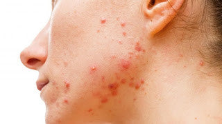 Side Of Face With Acne - Vu Skin System
