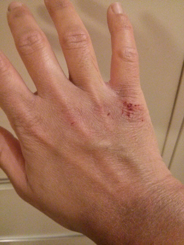 Dry Hand With Cracked Knuckle - Vu Skin System