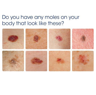 Melanoma On Skin - Vu Skin System