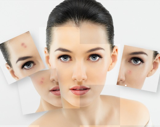Picture Of Woman With Skin Blemishes - Vu Skin System